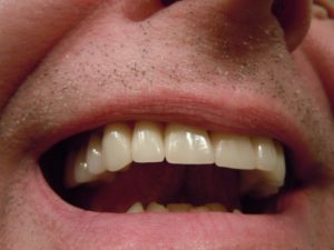 Lire la suite à propos de l’article Traitement de l’abcès dentaire