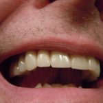 Traitement de l’abcès dentaire